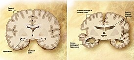 Оло кешенең баш мейеһе нормала (һулда) һәм Альцгеймер ауырыуы булған патология (уңда)