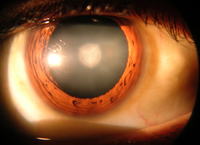 Cataracte sur un œil humain — vue grossie de l'examen à la lampe à fente. La chirurgie de la cataracte était pratiquée par Sushruta[107]. En Inde, la chirurgie de la cataracte était réalisée avec un instrument spécial appelé Jabamukhi Salaka, une aiguille courbe utilisée pour abaisser le cristallin et repousser la cataracte en dehors du champ de vision[107]. L'œil est ensuite enduit de beurre chaud et recouvert d’un pansement[107].