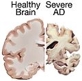Secţiune frontală prin două creiere (Procesare computerizată a imaginii). Dreapta: Accentuată reducere de volum al creierului unui pacient cu boala Alzheimer. Stânga: Creier normal.